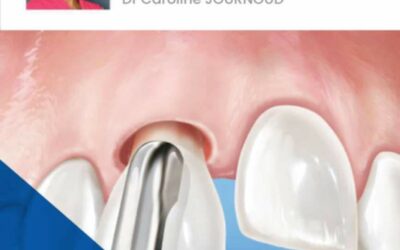 Master Class – La dent antérieure en implantologie : expertise, précision et esthétique au service du sourire