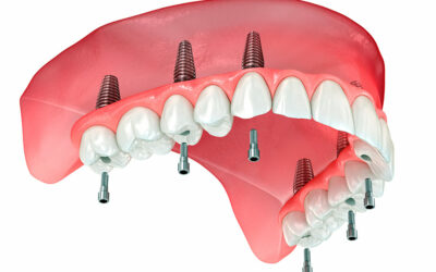 All-on-6 : une solution fiable et durable pour remplacer des dents manquantes